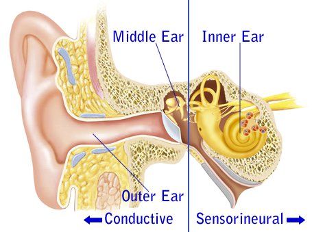 conductive-hearing-loss